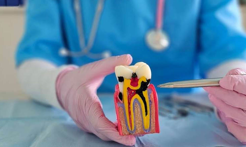 Why Root Canal Therapy Is Often the Best Solution for Tooth Pain in Kelowna