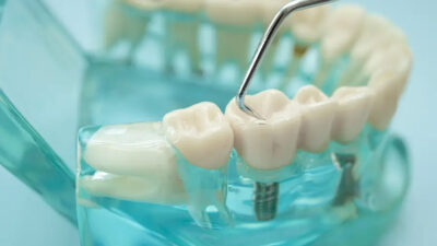 Dental Implants