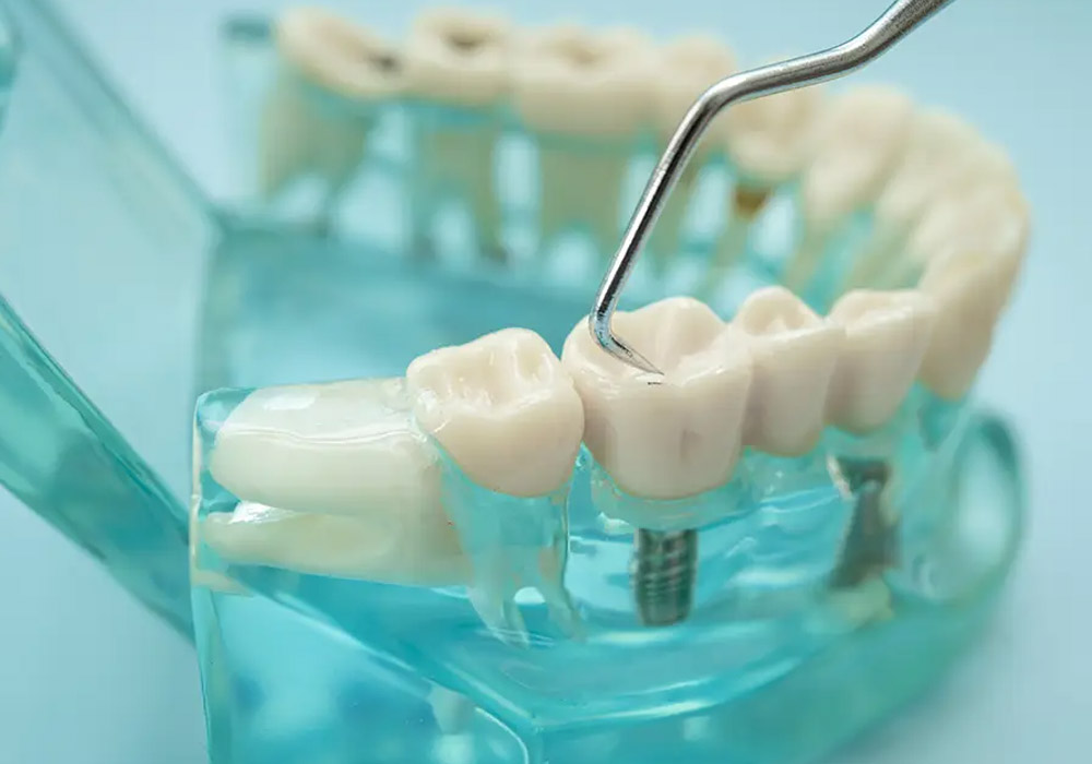 Dental Implants