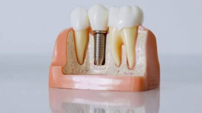 Common Questions Answered About Dental Implants in Downtown Vancouver