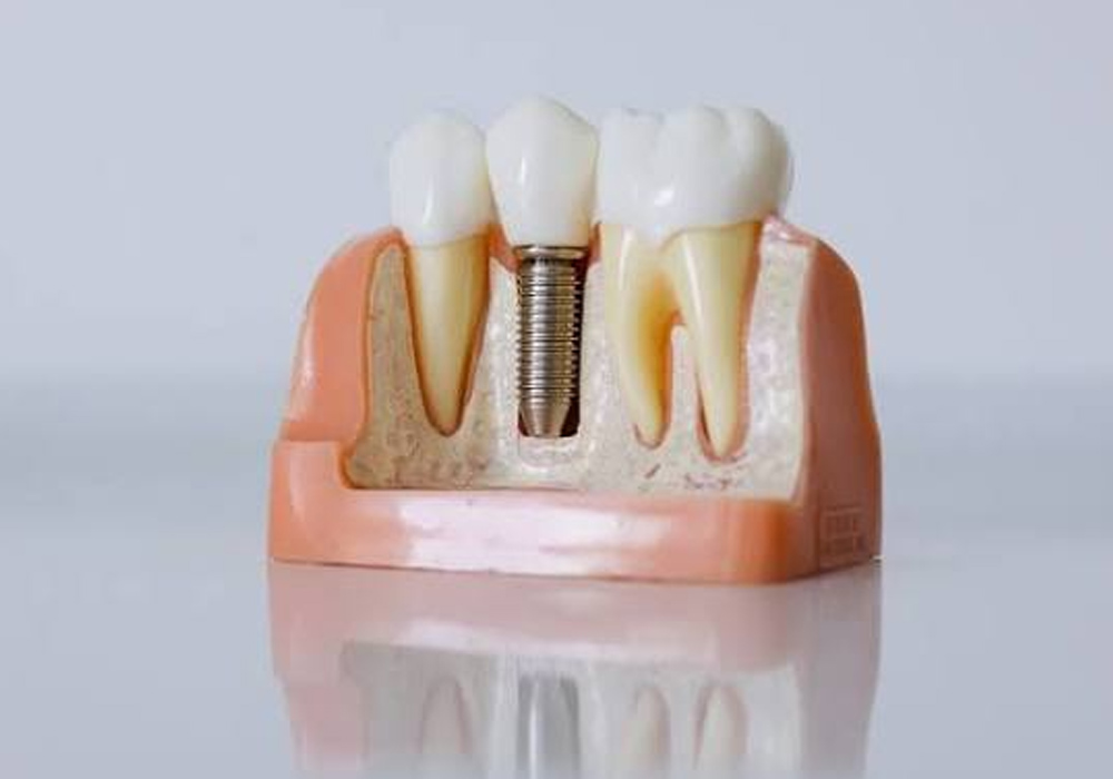 Common Questions Answered About Dental Implants in Downtown Vancouver