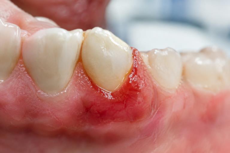 When Gum Disease Comes Guide to Dental Implant Readiness in Scottsdale and Phoenix Arizona