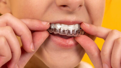 How Nova Orthodontics Helps Mukilteo Patients Decide If Invisalign Is Right for Them